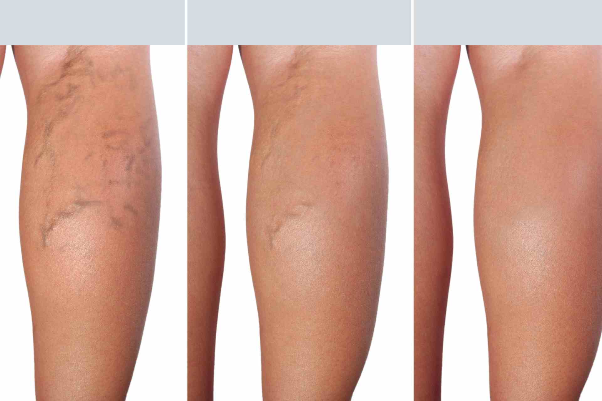 can varicose veins disappear with exercise